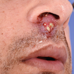 “Clear Skin Starts Here: Effective Blackhead Treatment Strategies”