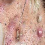 “How to Treat Blackheads and Cystic Acne Without Damaging Your Skin”