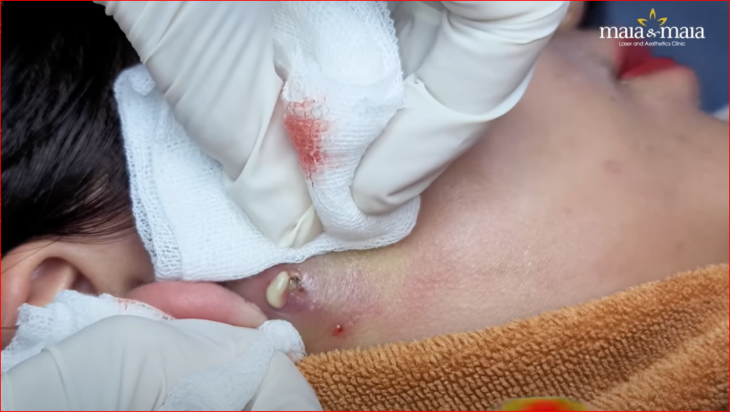 How to Get Rid of Blackheads Safely and Naturally