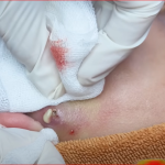 How to Get Rid of Blackheads Safely and Naturally