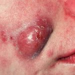 Understand treatment Acne Vulgaris