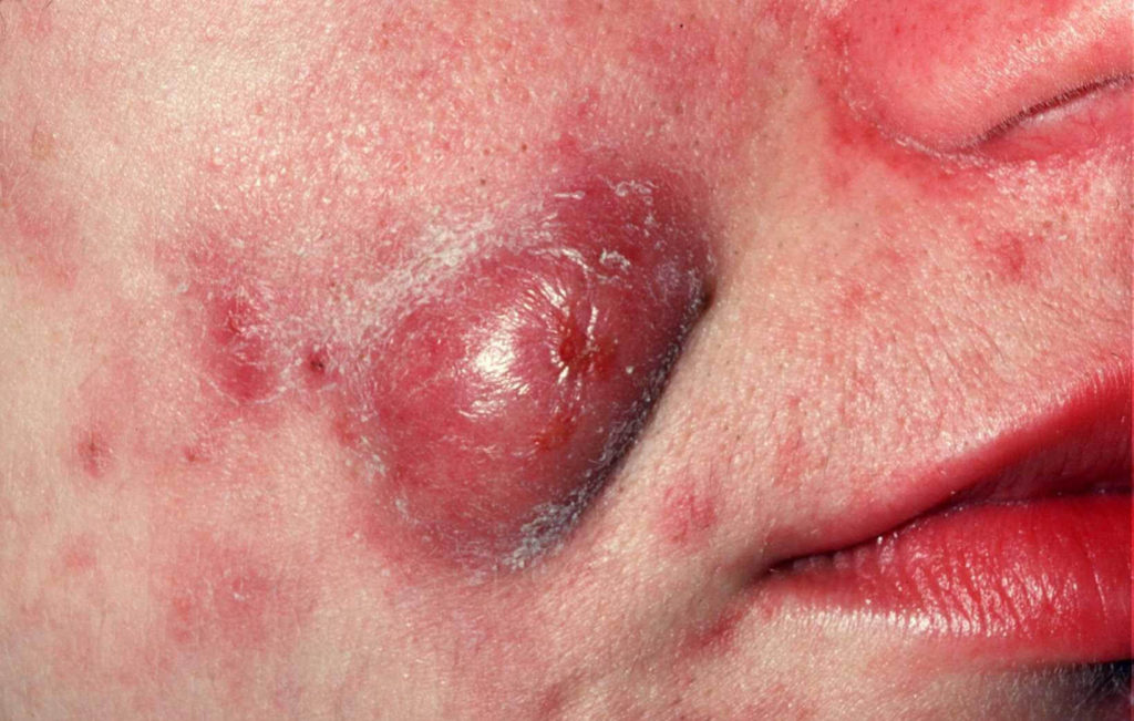 Understand treatment Acne Vulgaris