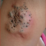 Treatment Modalities for Nevus Comedonicus: From Topicals to Surgery