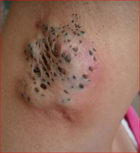 Treatment Modalities for Nevus Comedonicus: From Topicals to Surgery