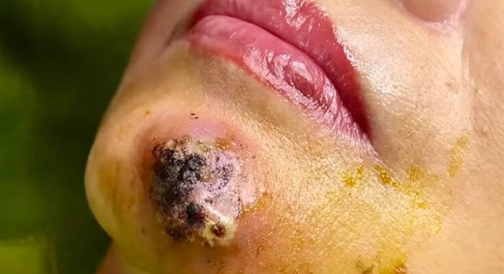 Can You Use Herbs to Treat Acne?