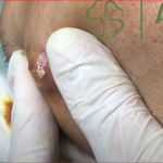 “Complete Treatment Guide for Huge Blackheads on the Face”
