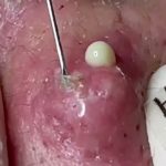 Big Cystic Acne Blackheads Extraction Blackheads