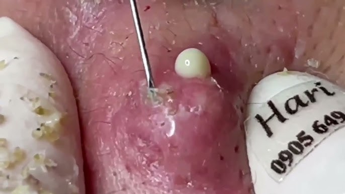 Big Cystic Acne Blackheads Extraction Blackheads