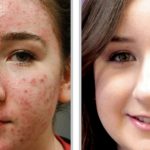 Options to Treat Acne Without Antibiotics