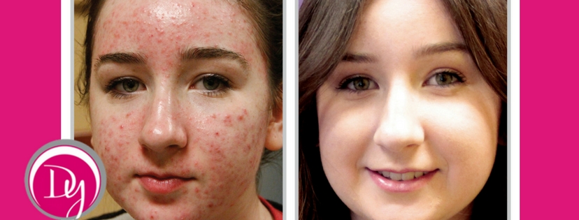 Options to Treat Acne Without Antibiotics