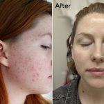The Korean Skin Care Routine That Changed One Woman’s Sensitive, Acne-Prone Skin