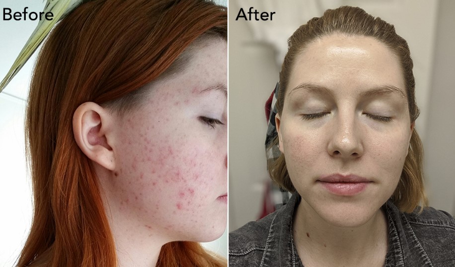 The Korean Skin Care Routine That Changed One Woman’s Sensitive, Acne-Prone Skin