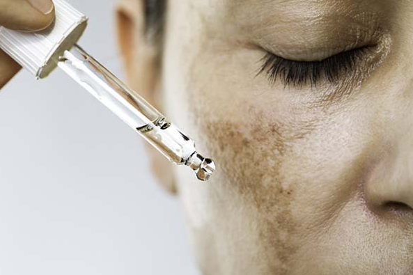 Demystifying hyperpigmentation: Causes, types, and effective treatments