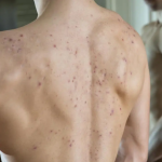 What causes pimples?