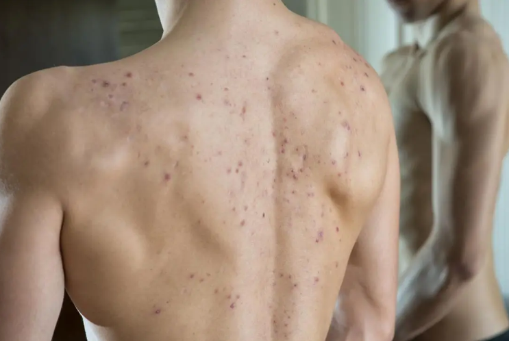 What causes pimples?