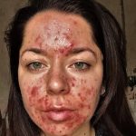Personal trainer, 25, told by doctors she had the ‘worst acne they’ve ever seen’ shares her striking before and after pictures following six months on medication and skincare products