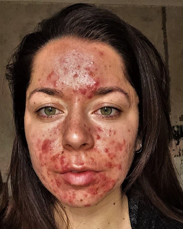 Personal trainer, 25, told by doctors she had the ‘worst acne they’ve ever seen’ shares her striking before and after pictures following six months on medication and skincare products